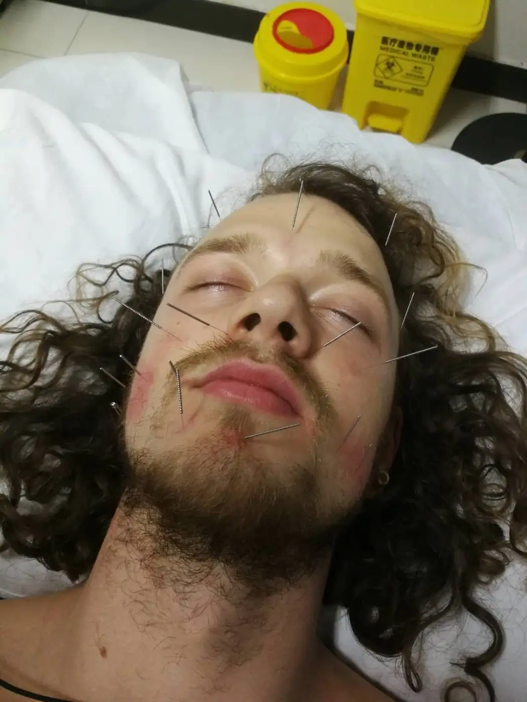 Acupuncture of facial points