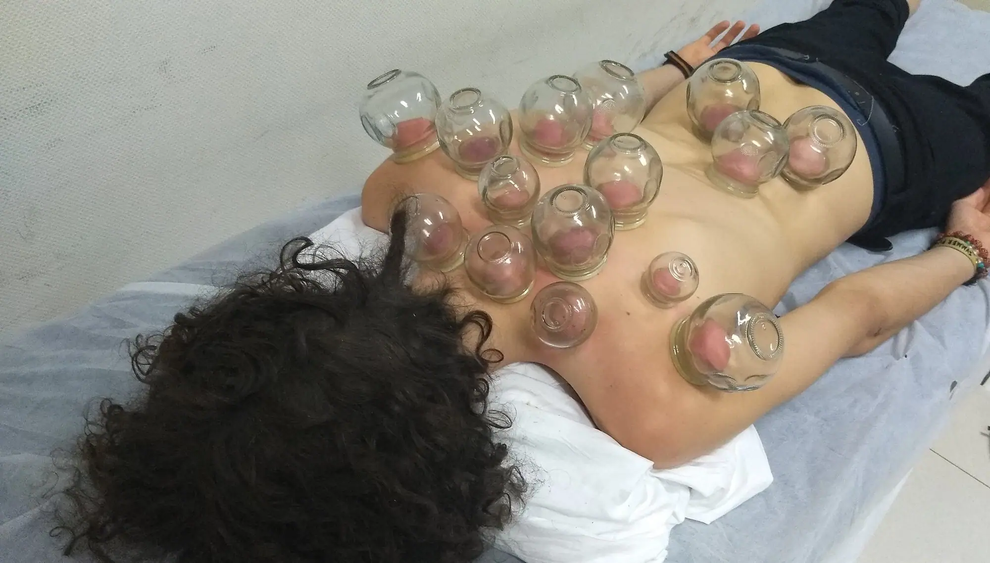 Cupping on the back during Tuina therapy